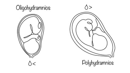 Oligohydramnios and Polyhydramnios