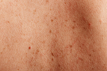Detailed image of freckles on human skin, focusing on the natural distribution and texture of the freckles.