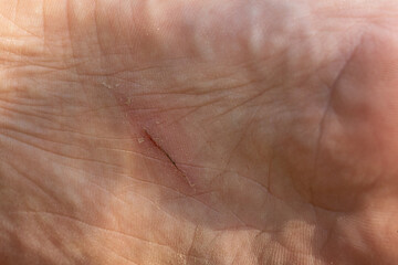 Close-up of a deep and painful cut on human skin