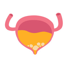 bladder cystitis infection. bladder stone