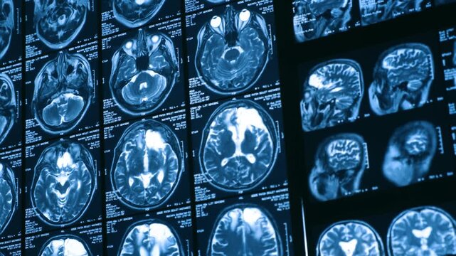 Close-up of CT scan with brain. Medicine, science and education MRI brain background. Magnetic resonance imaging. Tomography shot