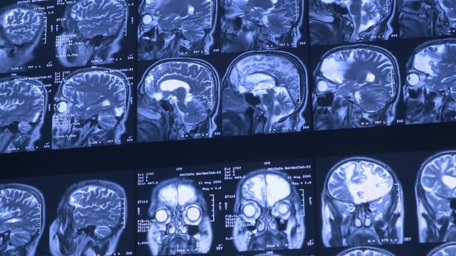 Close-up of CT scan with brain. Medicine, science and education MRI brain background. Magnetic resonance imaging. Tomography shot