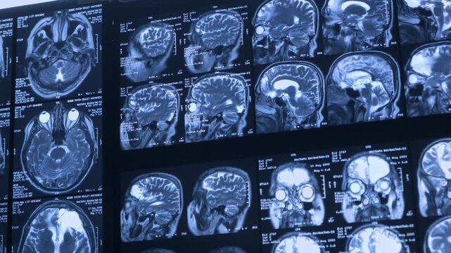 Close-up of CT scan with brain. Medicine, science and education MRI brain background. Magnetic resonance imaging. Tomography shot