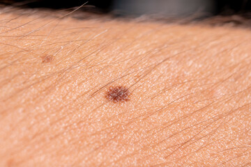 Texture of human skin with birthmark, closeup view
