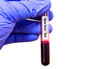 Obraz premium Biological specimens for Monkeypox virus test. It is also known as Moneypox virus, a double-stranded DNA, zoonotic virus and a species of the genus Orthopoxvirus in the family Poxviridae. Blood test 