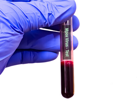 Biological specimens for Monkeypox virus test. It is also known as Moneypox virus, a double-stranded DNA, zoonotic virus and a species of the genus Orthopoxvirus in the family Poxviridae. Blood test 