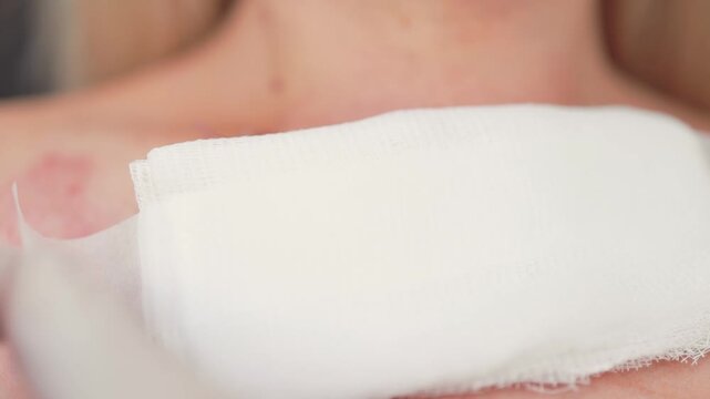 Scar after thyroidectomy. Surgical removal of the thyroid gland.