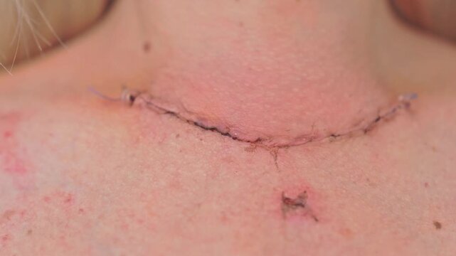 Scar after thyroidectomy. Surgical removal of the thyroid gland.