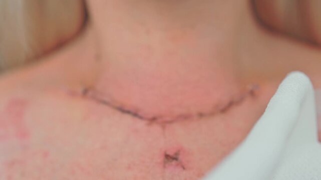 Scar after thyroidectomy. Surgical removal of the thyroid gland.
