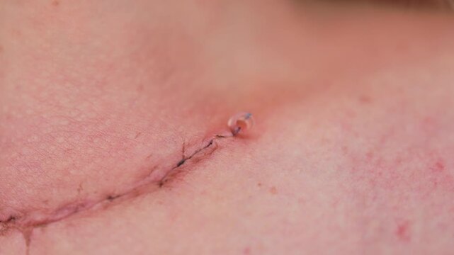 Scar after thyroidectomy. Surgical removal of the thyroid gland.