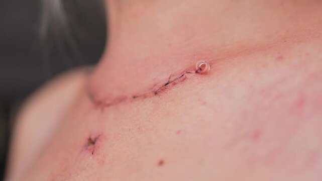 Scar after thyroidectomy. Surgical removal of the thyroid gland.