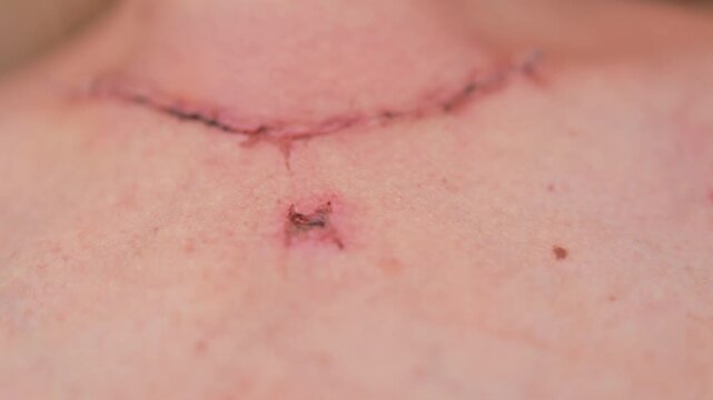 Scar after thyroidectomy. Surgical removal of the thyroid gland.