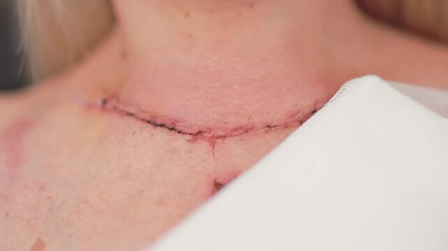 Scar after thyroidectomy. Surgical removal of the thyroid gland.