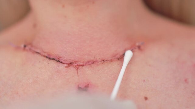 Scar after thyroidectomy. Surgical removal of the thyroid gland.