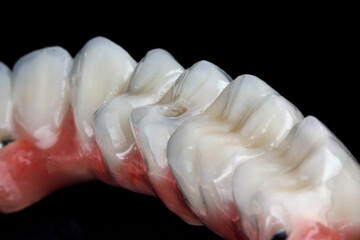 morphology of chewing teeth on a ceramic prosthesis on a black b