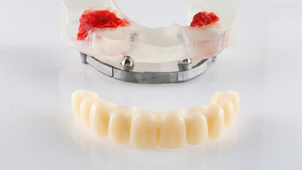 Temporary prosthesis of the upper jaw and beam on the model, photo on a white background © Dental Pro Content