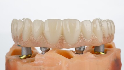 temporary dental prosthesis of the upper jaw on a model with a beam, shot on a white background © Dental Pro Content