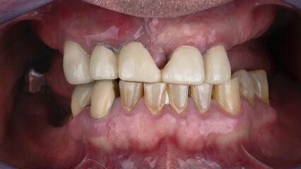 An elderly woman, about 55 years old, has bad teeth