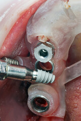 small dental implant before insertion into the surgical guide