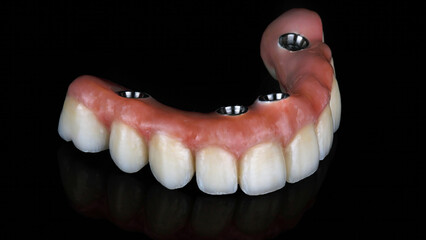 upper jaw prosthesis made of ceramic with pink gingiva and titanium, photographed against a black background © Dental Pro Content