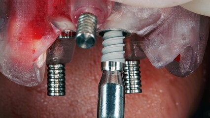 an excellent moment for the installation of a dental implant through the surgical template of the upper jaw © Dental Pro Content