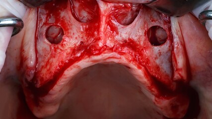 prepared upper jaw during a complex operation before implantation © Dental Pro Content
