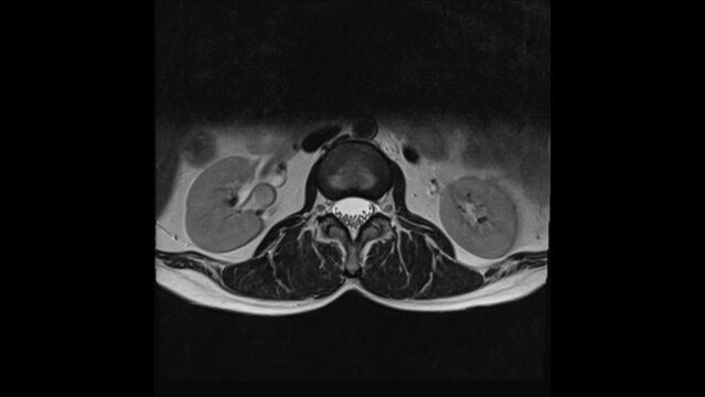 MRI scan of lumbar spines nomal axial T2