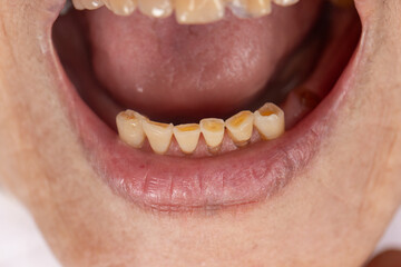 Attrition tooth due to interaction with other teeth in elderly woman.