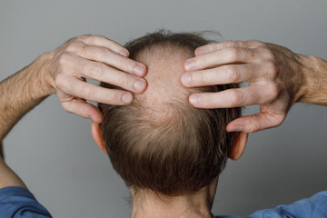 Hair loss person. Balding man head close-up