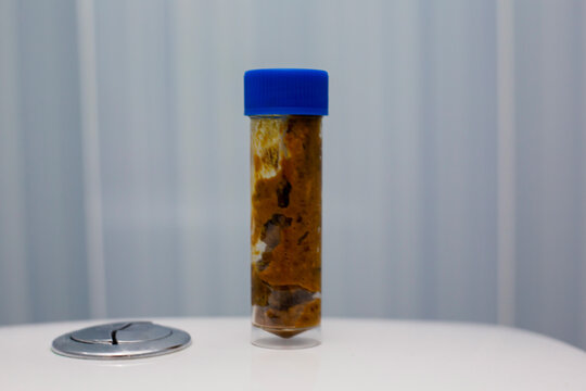 A real stool sample for analysis in the laboratory. stool analysis