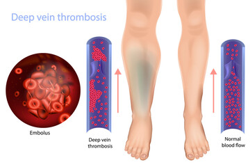 Deep vein thrombosis and Normal blood flow. Abnormally of blood floow. Medical Diagram 