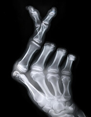 X-ray Image of a Human Hand make the shape as shown in the finger heart sign