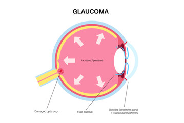 Glaucoma eye pressure