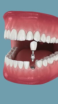 Dental implant and ceramic crown. Medically accurate tooth 3D Animation