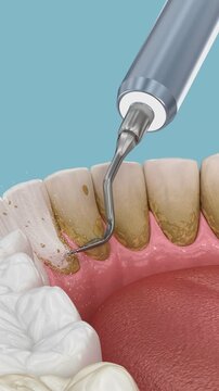 Oral hygiene: Scaling and root planing (conventional periodontal therapy). Medically accurate 3D Animation of human teeth treatment