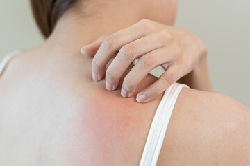 Sensitive skin allergic concept, Woman itching on her back have a red rash from allergy symptom and...