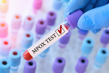 Obraz premium Doctor holding a test blood sample tube with Monkeypox virus (MPXV) .The virus is transmitted from animals to humans. Infected people suffer from fever, cough, headache, nausea and vomiting