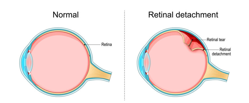 Retinal detachment. Cross section of the eye