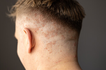 Obraz premium Psoriasis on the skin close-up, scalp, photos of dermatitis and eczema, skin problems concept, dermatology banner