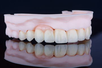 High-quality frontal dental bridge with artificial gum made of zirconium for fixation to upper jaw.