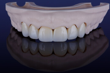 High-quality six dental crowns made of zirconium for fixation to the frontal teeth of upper jaw.