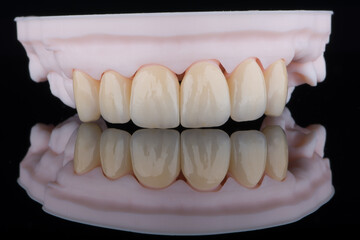 Quality dental crowns of upper jaw made of zirconium stylized as an old teeth on 3D printed model. © gorynvd