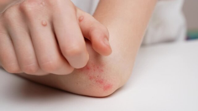 Child with warts on his hands scratches reddened, inflamed areas on his elbow, close-up. Child suffers from attacks of allergies and dermatitis. Papillomavirus. Dermatological diseases of skin concept