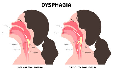 Difficulty swallowing of Dysphagia disorder with cough choking when eating food