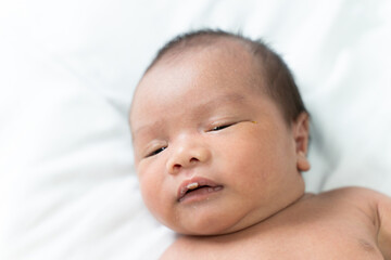 Nasolacrimal duct obstruction, The baby has a blocked tear duct and eye mucus.