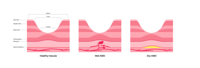 Macular degeneration poster
