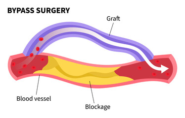 Bypass surgery for Peripheral artery disease with foot ulcer of clot leg veins by fatty or injury that cause pain and High blood pressure