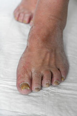 Skin damage, a wound on a woman's legs. Diseases of the skin. Damage to the nail plate, nail by a fungal disease