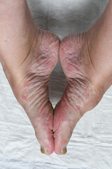 Skin damage, a wound on a woman's foot.  Diseases of the skin. Damage to the nail plate, nail by a fungal disease