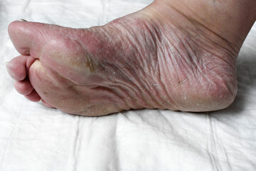 Skin damage, a wound on a woman's legs. Diseases of the skin. Damage to the nail plate, nail by a fungal disease